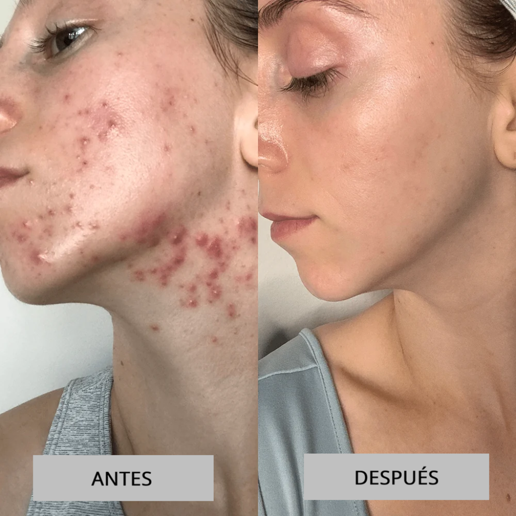 Nova Sculpt — Alta Frecuencia para Piel Radiante y Sin Acné