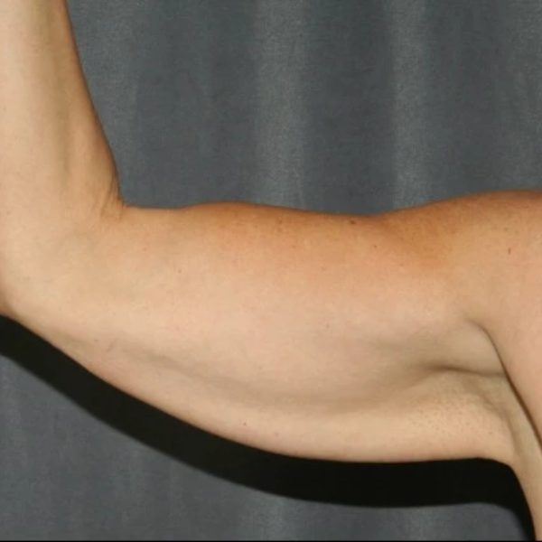 Antes