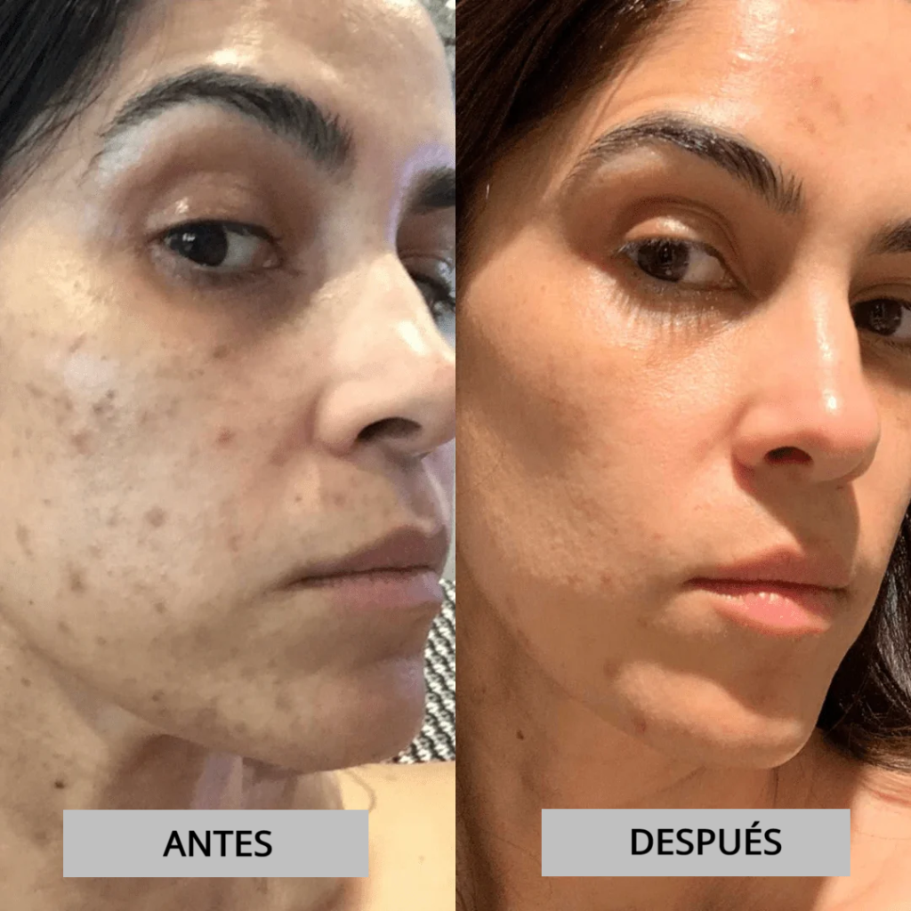 Nova Sculpt — Alta Frecuencia para Piel Radiante y Sin Acné